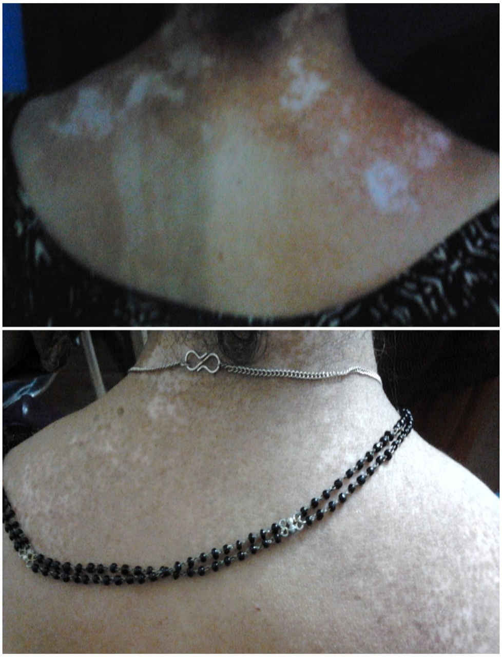 VITILIGO