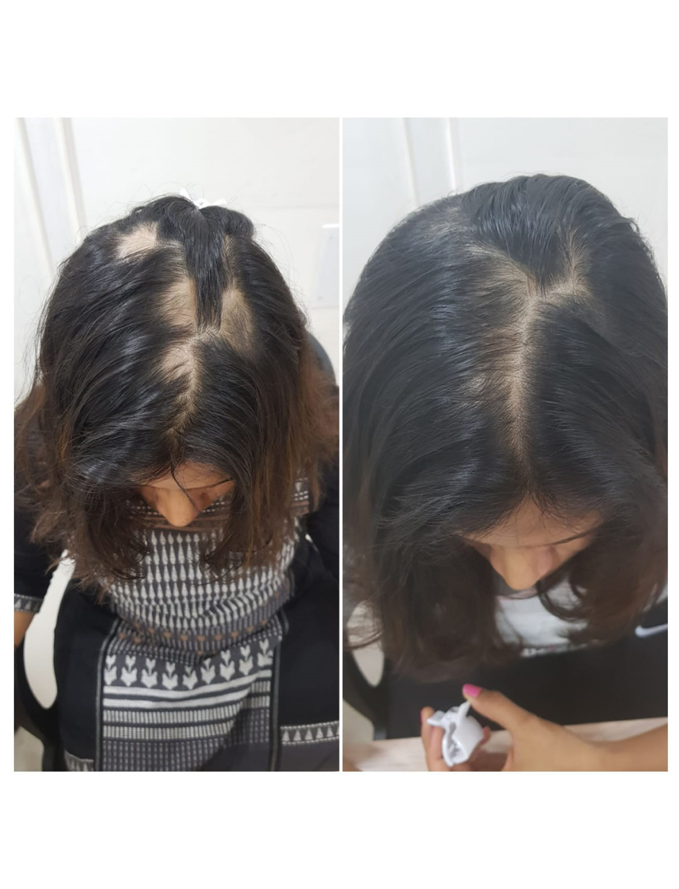 Alopecia Areata