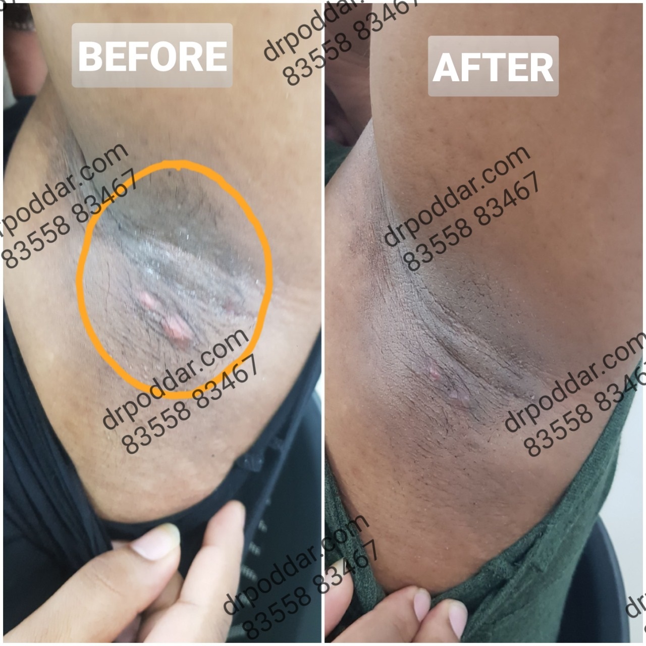 RECURRENT ABSCESS