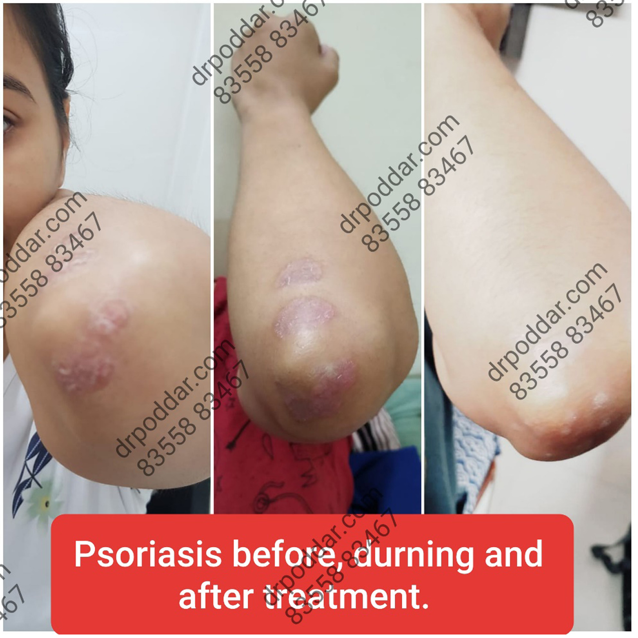 PSORIASIS- ‘PSO’ WHAT!